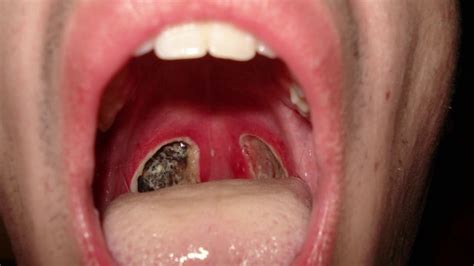 My Tonsil Stones Do I Need A Tonsillectomy Youtube