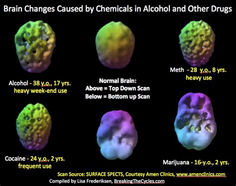 Brain Scan On Drugs Brain Mind Article
