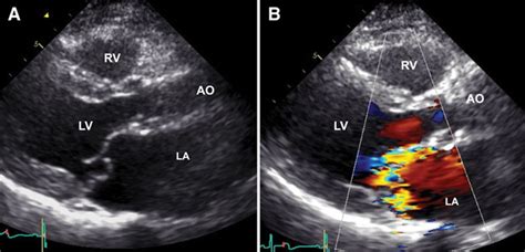 Familial Clustering Of Mitral Valve Prolapse In The Community Circulation