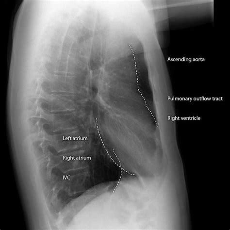 Sites Of Silhouette Sign On The Lateral Chest Radiograph Include 3