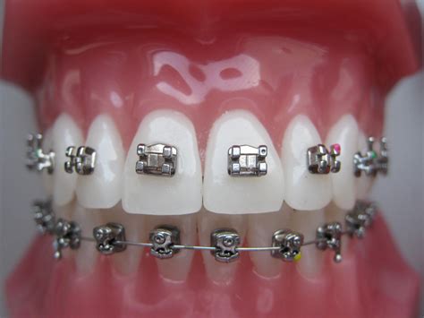 Fixed Orthodontic Appliances Specialized Dental Studio Aponia