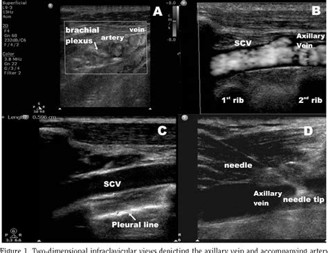 Axillary Artery Ultrasound