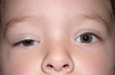 Congenital Ptosis Droopy Eyelid Fort Worth Eye Associates