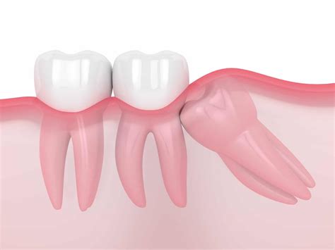The Results Of Postponing Wisdom Tooth Extraction Santa Rosa Oral Surgery