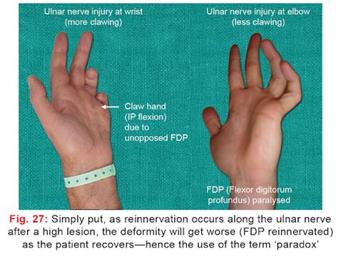Ulnar Nerve Lesions Causes Diagnosis
