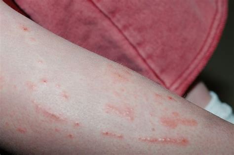 Skin Rashes Types And Causes