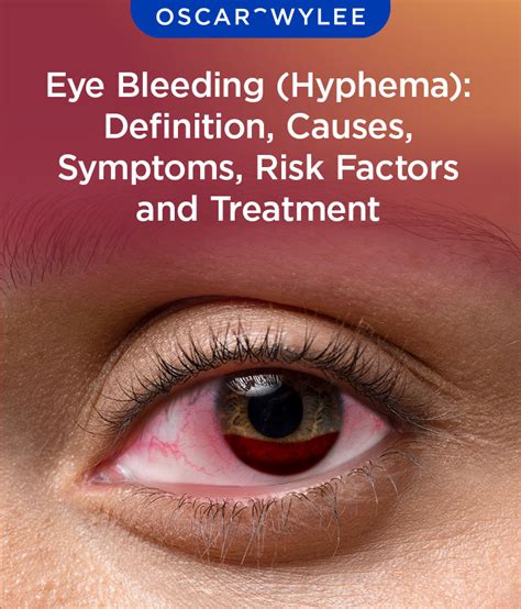 Eye Bleeding Hyphema Definition Causes Symptoms Risk Factor And Treatment