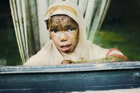 Little Boy Leper We Visited A Leprosy Hospital In Addis La Flickr