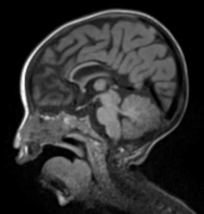 Corpus Callosum Dysgenesis And Colpocephaly Radiology Case Radiopaedia Org