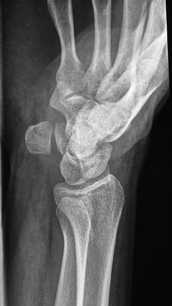 Pisiform Fractures Wikiradiography