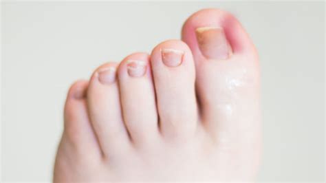 Ingrown Toenails Morecrofts Podiatry Services Lilydale