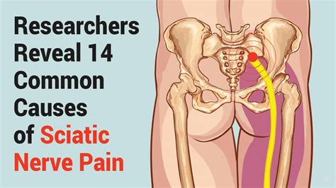 Researchers Reveal 14 Common Causes Of Sciatic Nerve Pain