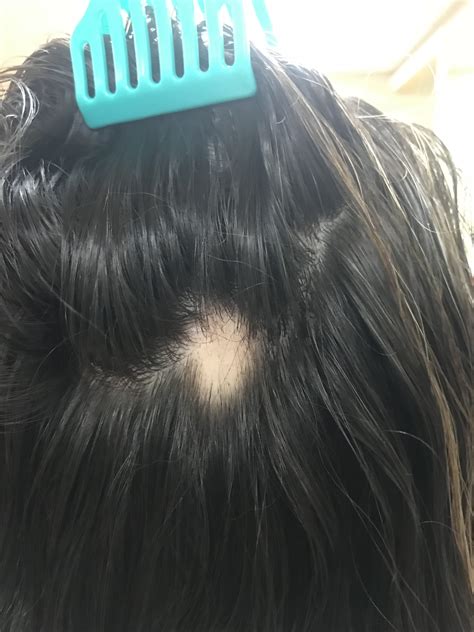 Bald Spot When Crazy Meets Exhaustion