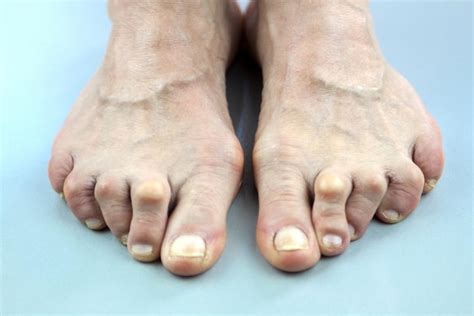 Arthritis In Toes Procedures And Pain Relief