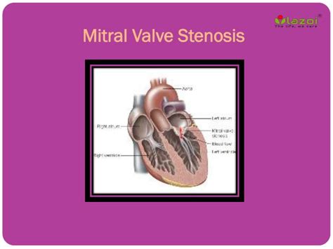 Ppt Mitral Valve Stenosis Causes Symptoms Daignosis Prevention