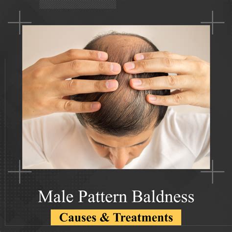 What Are The Causes And Treatments For Male Pattern Baldness
