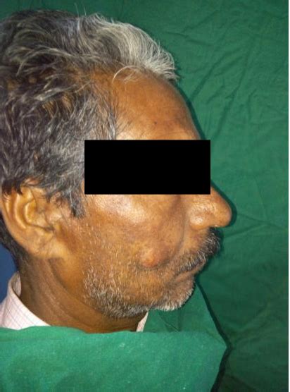 Figure 1 From Surgical Management Of Infected Sebaceous Cyst In Cheek