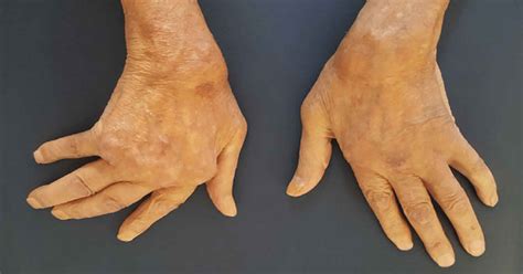 Ulnar Deviation Rheumatoid Arthritis Hot Sex Picture