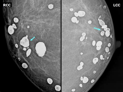 Atlas Of Breast Cancer Early Detection