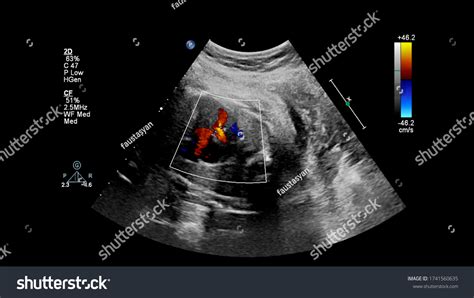 Ultrasound Examination Fetal Heart Hypoplastic Left Stock Photo