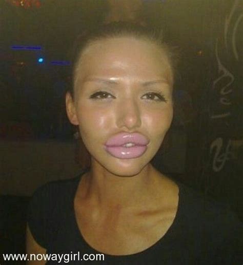 Why Do So Many Women Want These Abnormal Botox Lips Nowaygirl