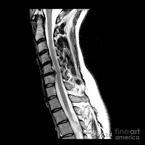 Cervical Disc Herniation X Ray