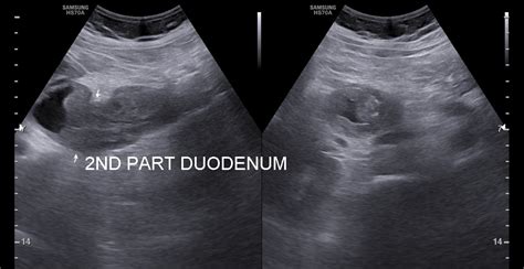 Duodenal Cancer Shivi X Ray And Ultrasound Centre Shivi Imaging
