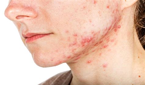 Acne Types And The Perfect Home Remedies For Each One