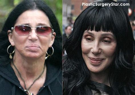 Cher Gets Plastic Surgery For A Facelift Bad Plastic Surgeries Plastic Surgery Gone Wrong