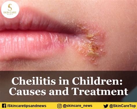 Cheilitis In Children Causes And Treatment