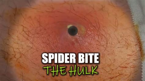 Texas Worst Spider Bite Hulks Aftermath 3 Top Ten All Time Youtube