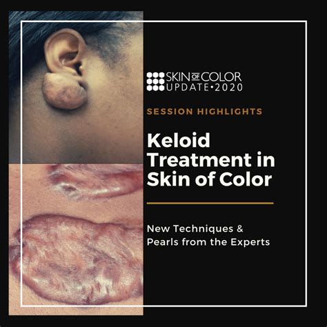 Keloid Treatment In Skin Of Color New Techniques Pearls From The