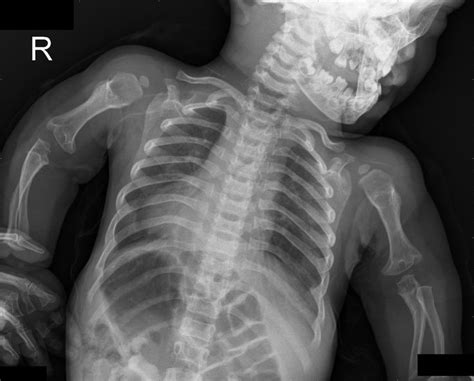 Achondroplasia Radiology Case Achondroplasia