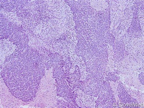 Invasive Squamous Cell Carcinoma Of Anus