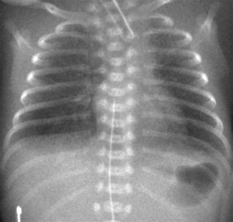 Lung Disease In Premature Neonates Radiologic Pathologic Correlation