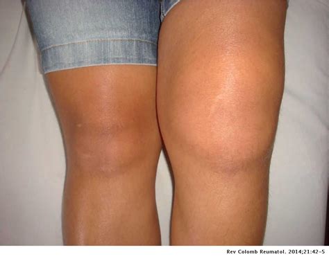 Sinovitis De Rodilla Reactiva Inflamacion Causas Sintomas Y Tratamiento