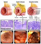 Images of Colon Pain Medication