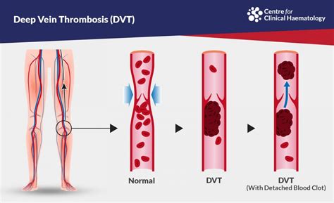 Deep Vein Thrombosis DVT CFCH Centre For Clinical Haematology