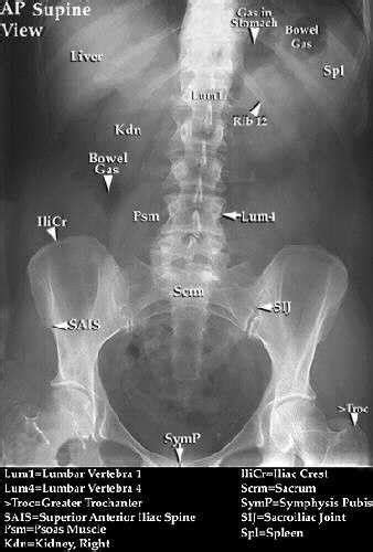 Kub X Ray Labeled What Is Abdominal X Ray Or Kub Medical