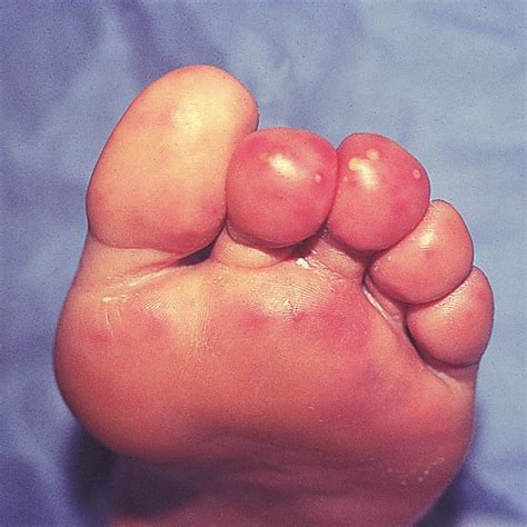 Erythematous Nodules On Plantar Surfaces Affecting Mainly Anterior