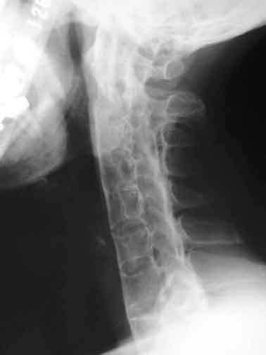 Treatment for cervical spondylosis depends on the severity of your signs and symptoms. Ankylosing Spondylitis Treatment, Neurological Symptoms ...