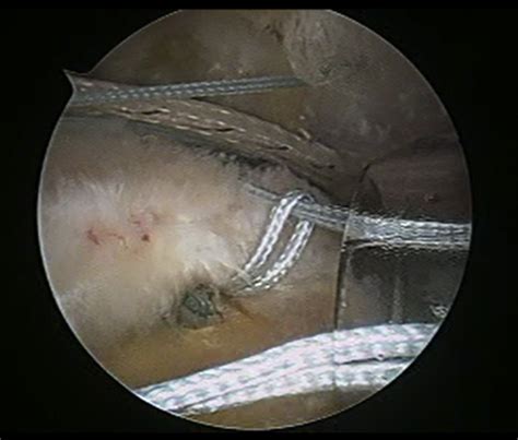 Hybrid Repair Of Large Crescent Rotator Cuff Tears Using A