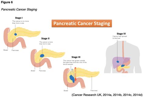 Pancreatic Cancer For Aprns Nursing Ce Course Nursingce