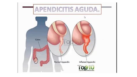 Apendicitis Salud Apuntes De Medicina Udocz