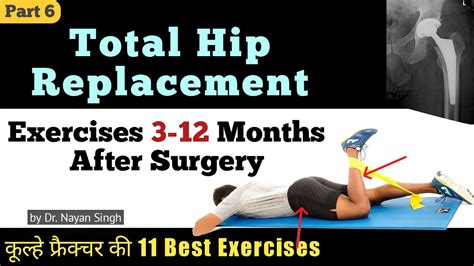 Top 11 Total Hip Replacement Exercises 3 12 Months After Surgery Hip