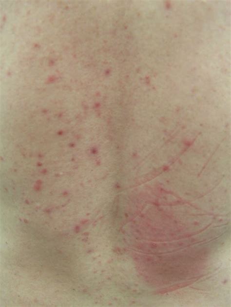 Itchy Rash On Back