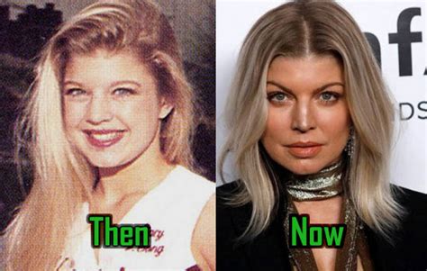 Fergie Plastic Surgery Did She Really Have It Celebritysurgeryicon