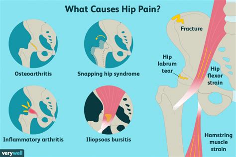 The peroneal consists of a group of muscles located in the lower leg bone, or the fibular—the reason. Hip Pain might not be a Hip Problem | Miller Orthopedic ...