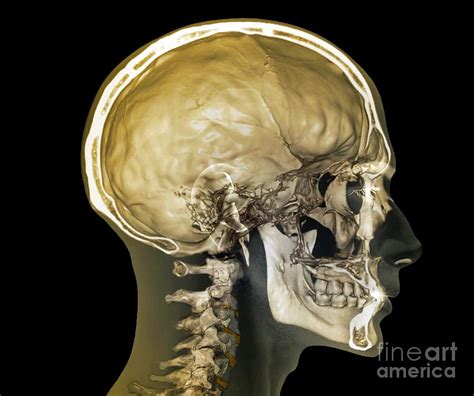 Normal Head And Neck 3d Ct Scan Photograph By Zephyr Fine Art America