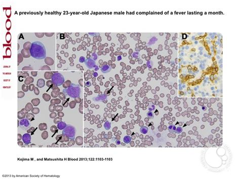 Hepatosplenic T Cell Lymphoma Appearing In The Peripheral Blood